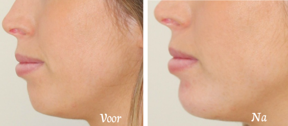 lippen dreamclinics