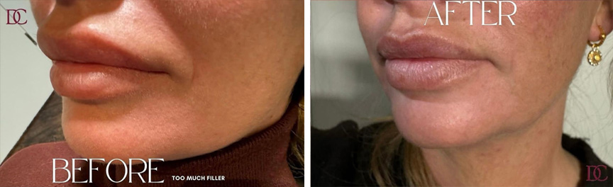 lippen dreamclinics